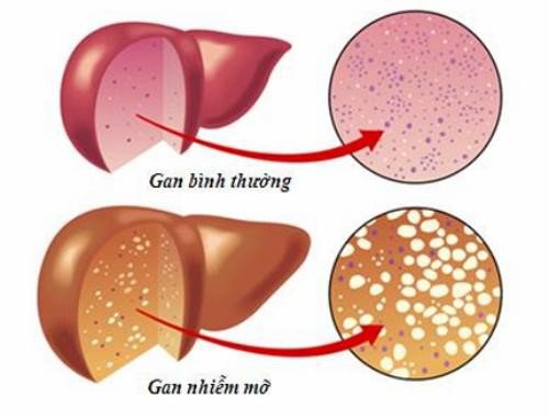 Gan nhiễm mỡ là gì? Chế độ dinh dưỡng cho người bị gan nhiễm mỡ