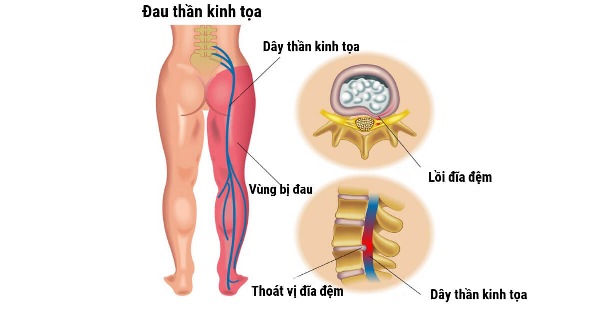 Đau thần kinh tọa là gì? Nguyên nhân và các biện pháp phòng tránh